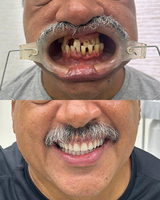 Caso de transformação com implante dentário 2